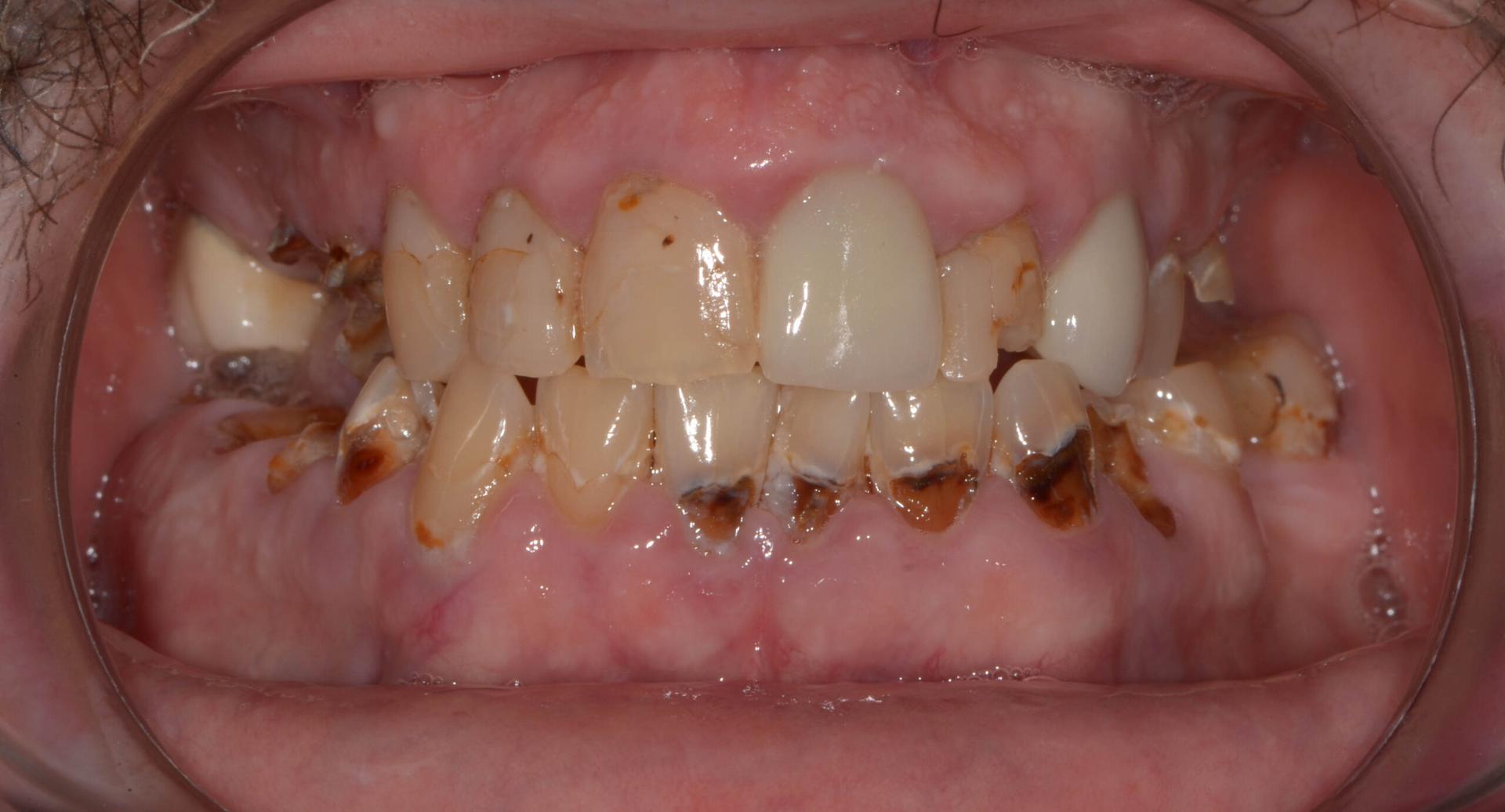 Rising Tooth Decay Among School Children Alarms Health Experts in Ghana