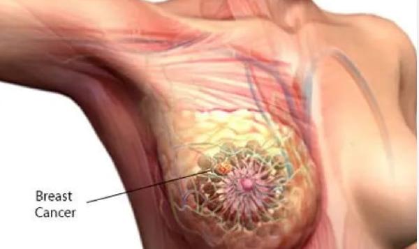 Breast Cancer Cases in Women Predicted to Rise by a Third Globally